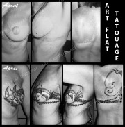 recouvrement cicatrices - sein - 001